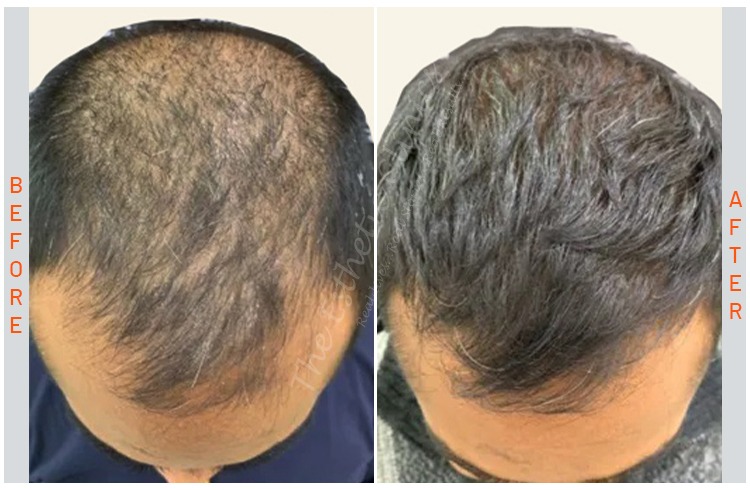 Exosomes-Hair-Treatment